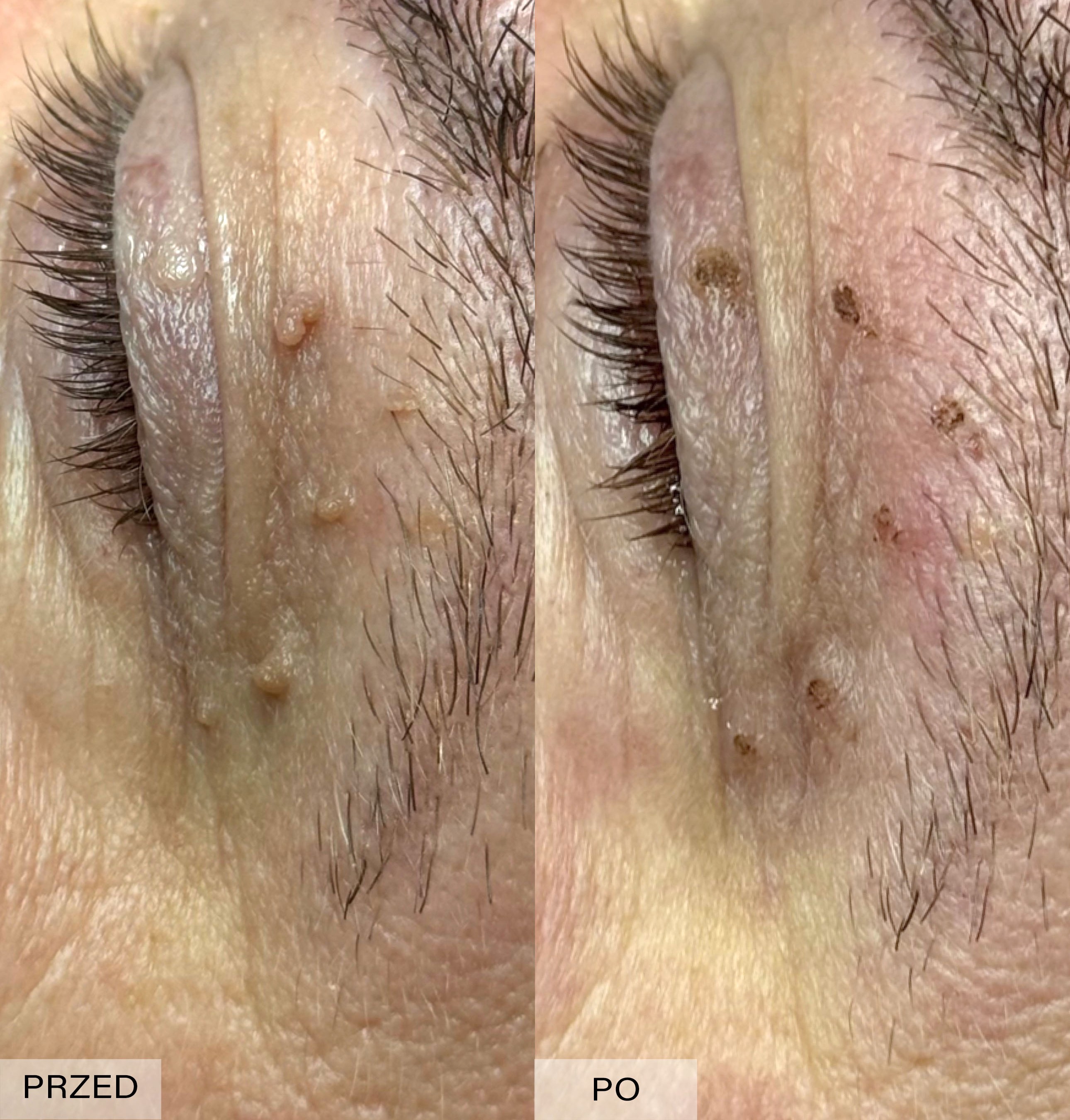 Efekt elektrokoagulacji